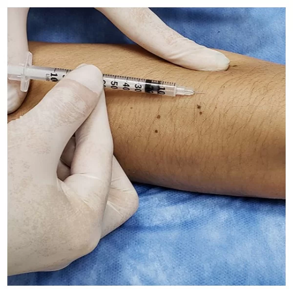 Prueba de Tuberculina (Mantoux)
